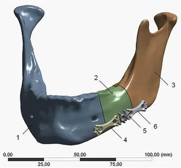 Alveolar bone repair