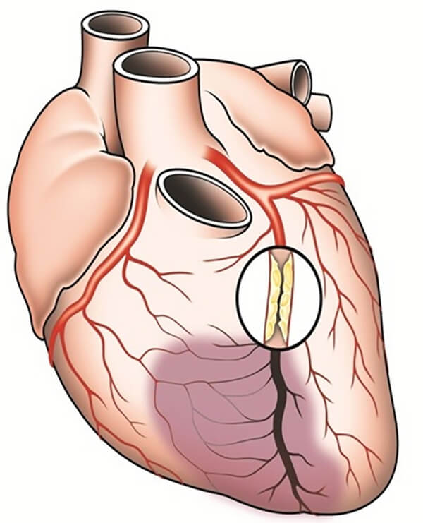 Location of coronary heart disease