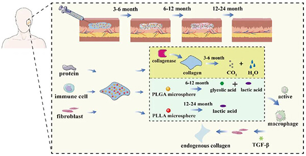 PLA and PLGA microspheres for soft tissue augmentation