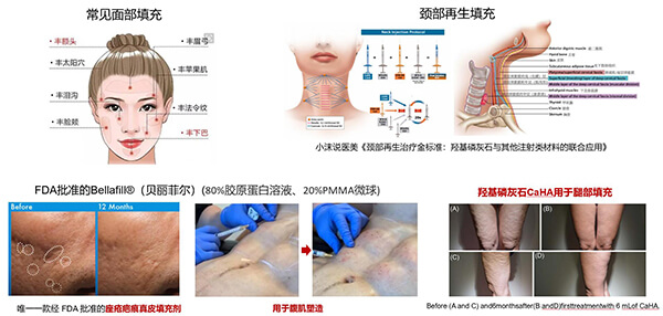 Tissue filling application scenarios